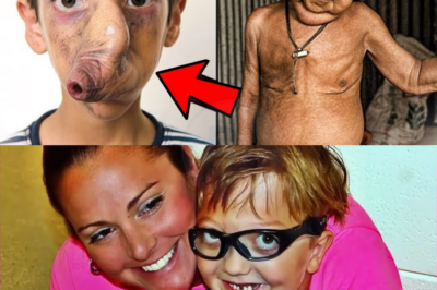 Les Personnes Les Plus Inhabituelles Atteintes De Maladies Très Rares